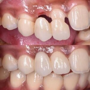 dental bridges & crowns