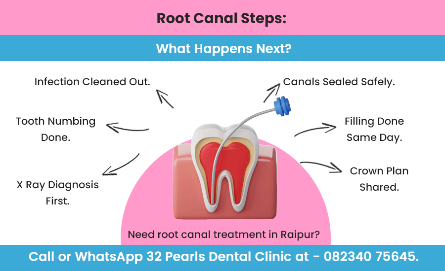 root-canal-steps--what-happens-next