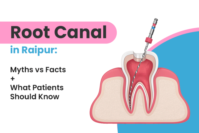 Root Canal in Raipur: Myths vs Facts + What Patients Should Know