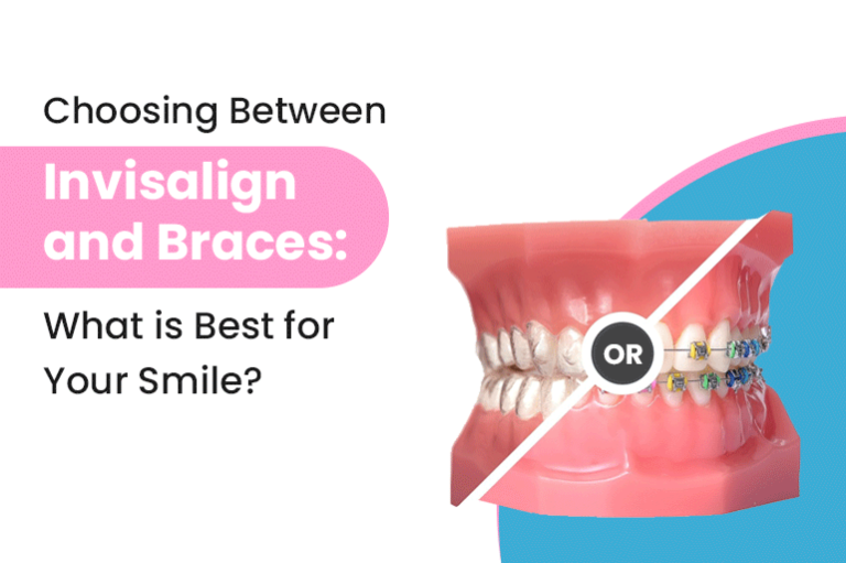 Choosing Between Invisalign and Braces: What is Best for Your Smile?