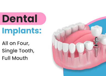 Single tooth, All-on-Four and full-mouth dental implant options at 32 Pearls, Raipur