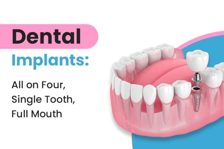 Dental Implants: All on Four, Single Tooth, Full Mouth