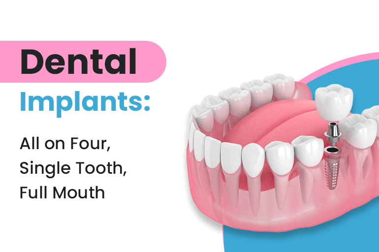 Single tooth, All-on-Four and full-mouth dental implant options at 32 Pearls, Raipur