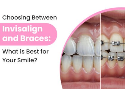 invisible braces Raipur