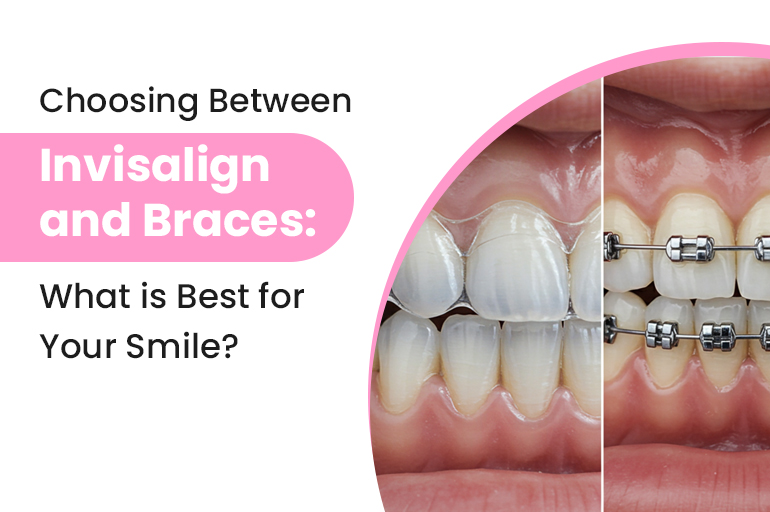 Clear aligners and traditional braces compared to help patients choose, 32 Pearls Raipur