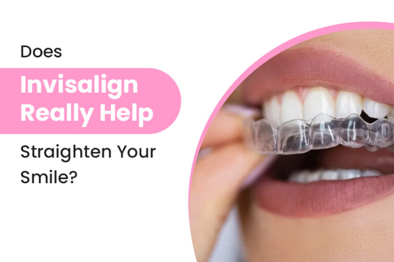 Does Invisalign Really Help Straighten Your Smile?