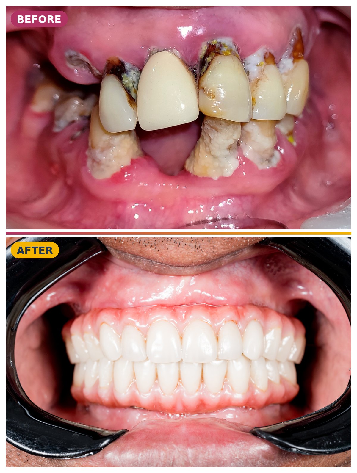 Full-mouth teeth transformation result at 32 Pearls Dental Clinic, Raipur