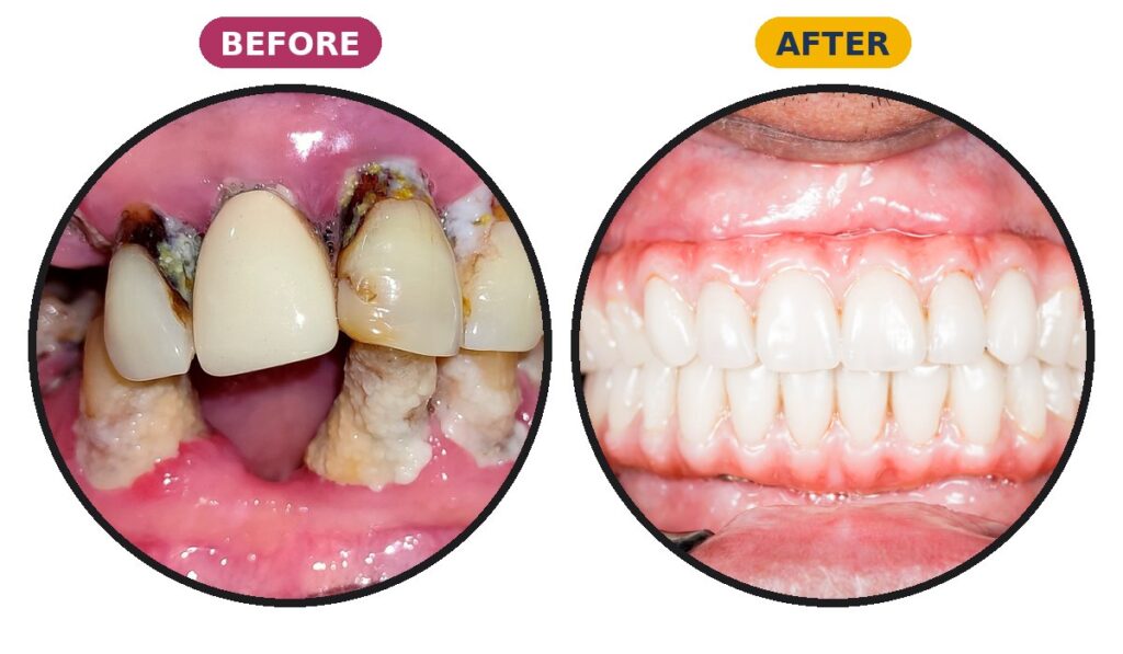 Before and after smile transformation at 32 Pearls Dental Clinic, Raipur