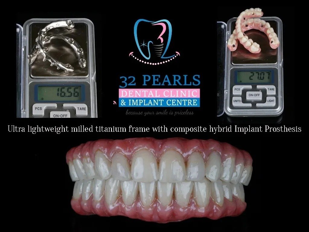 Titanium hybrid prosthesis for full-arch implants, 32 Pearls Dental Clinic Raipur